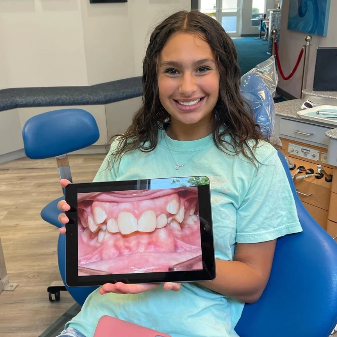 clear aligner