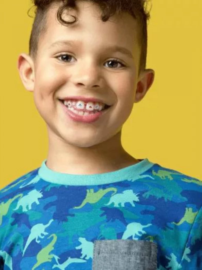 Invisalign First.png