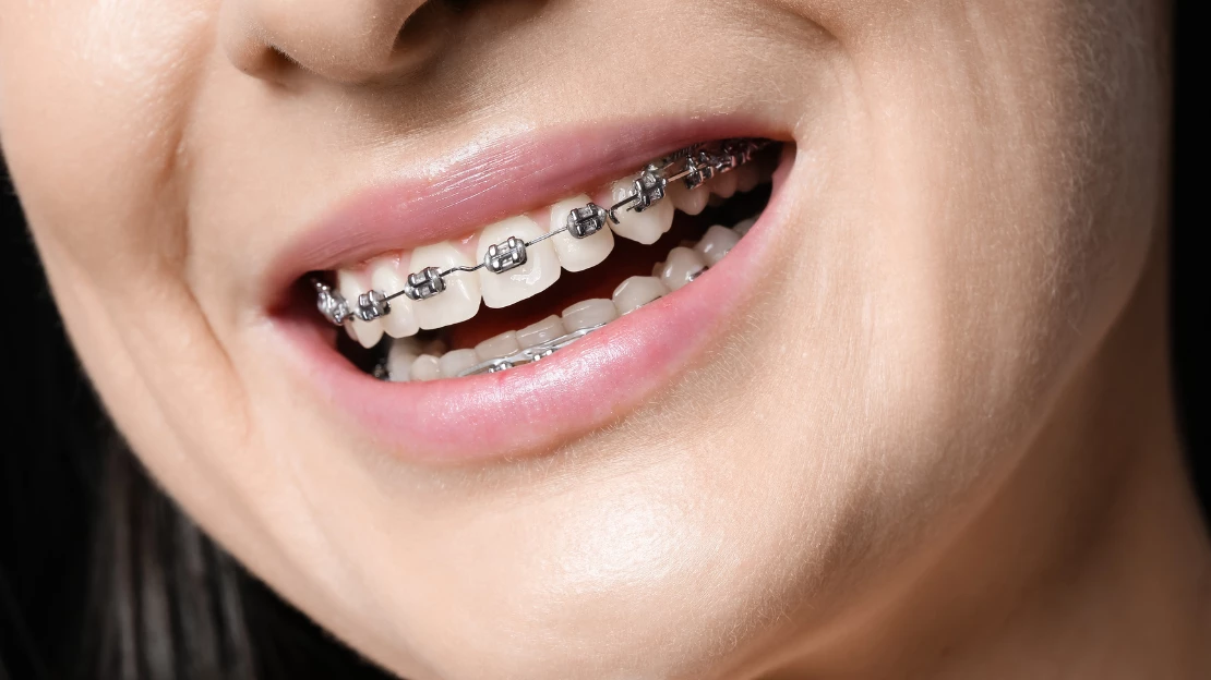 SEO Fixing Crooked Teeth.
