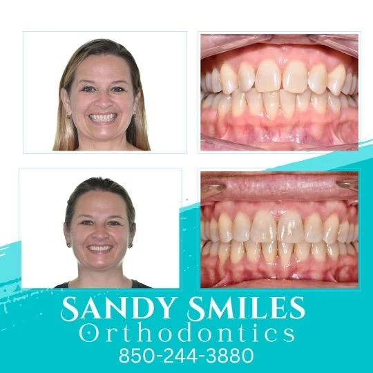 Cost of Invisalign Sandy 