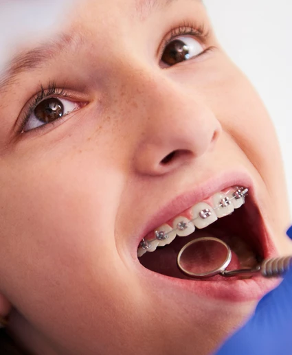 clear aligner