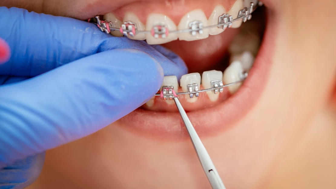 SEO Braces.png